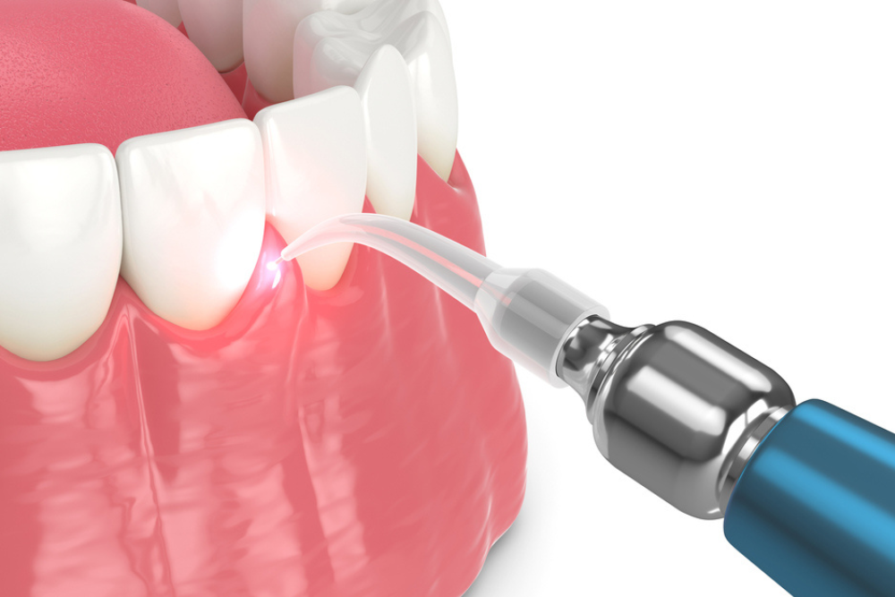 apoksesi_periodontikon_thilakon_me_laser
